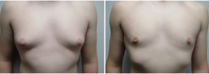 gynecomastia-surgeon-long-island-before-after-30-1